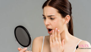 Shocked Young Woman Acne on Face