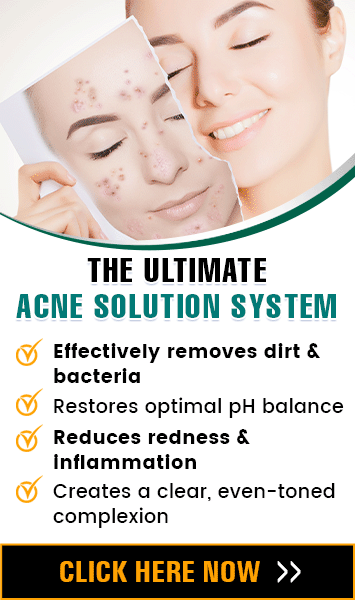 acne-solution system