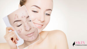 Skin-Care-Routine-for-Acne-and-Blemishes