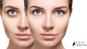 Natural remedies for dark circles