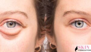 Best Way To Get Rid Of Crow's Feet