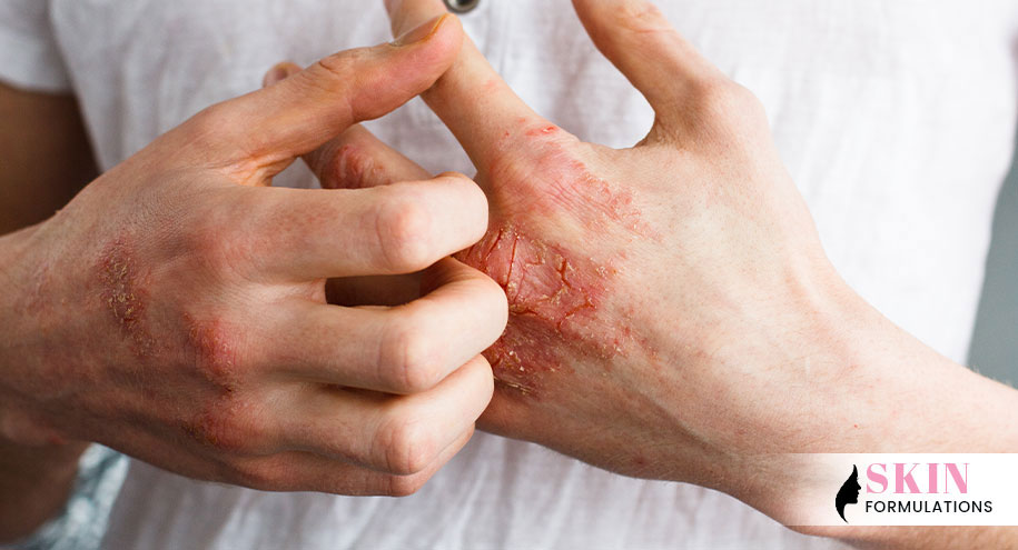 Causes an Eczema Flare-Up in the Winter
