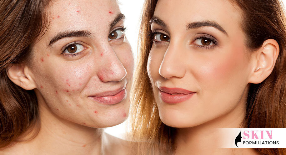 Cover Up Every Type of Acne with Makeup
